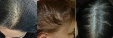 Выпадение волос у женщин – лечение – Публикации – Лаборатория Ан-Тек