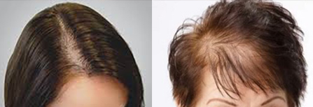 Выпадение волос у женщин – лечение – Публикации – Лаборатория Ан-Тек