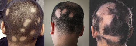Восстановить рост волос на голове у мужчин клиника