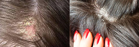 Где лечат выпадение волос у женщин