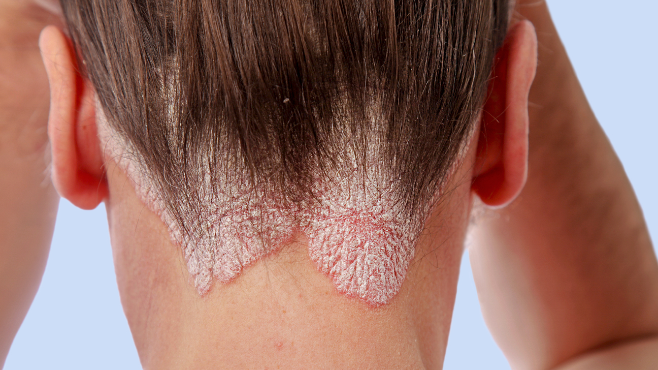 Домашние способы лечения себореи кожи головы