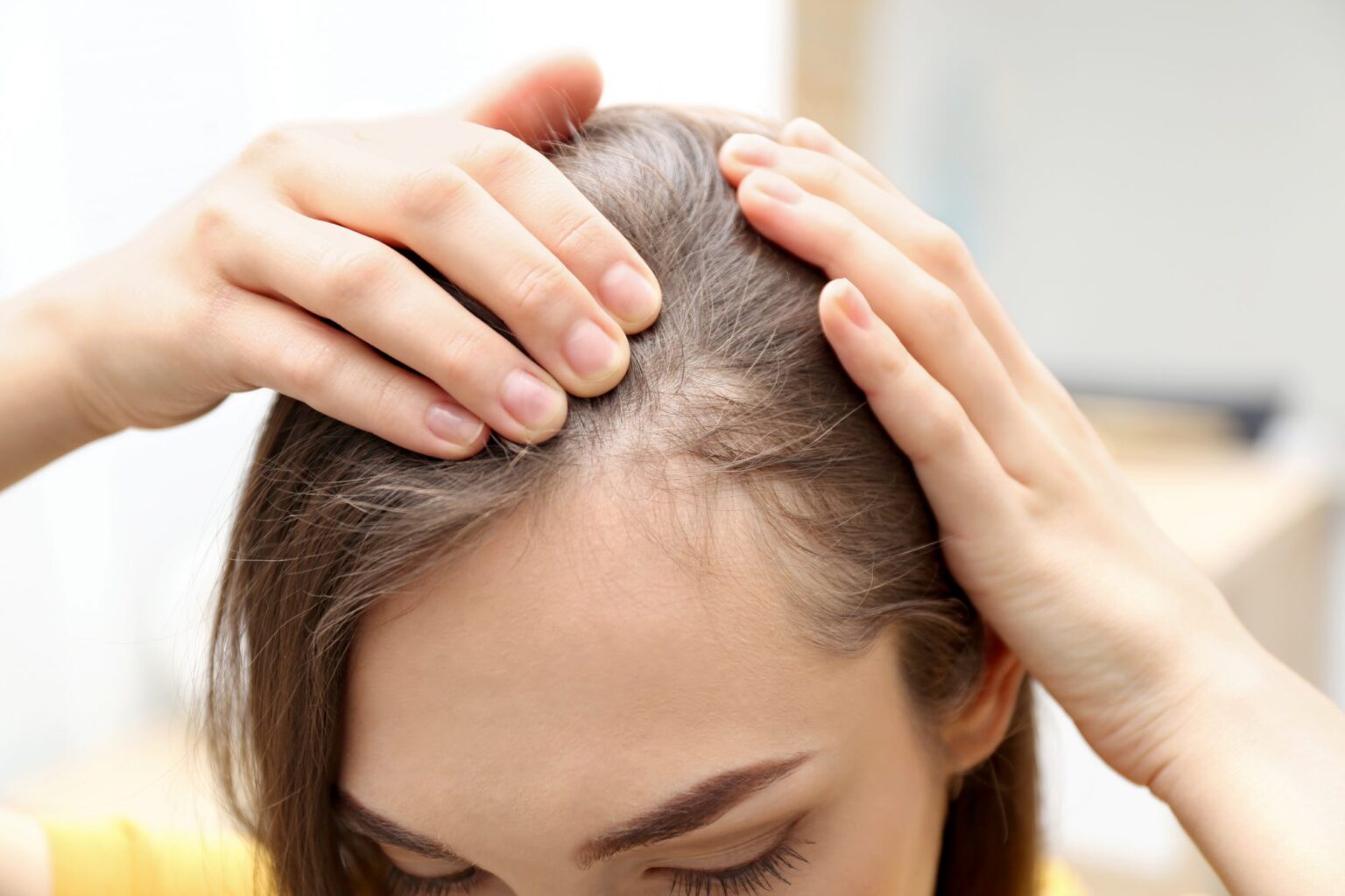 Сильное выпадение волос у женщин – Публикации – Лаборатория Ан-Тек